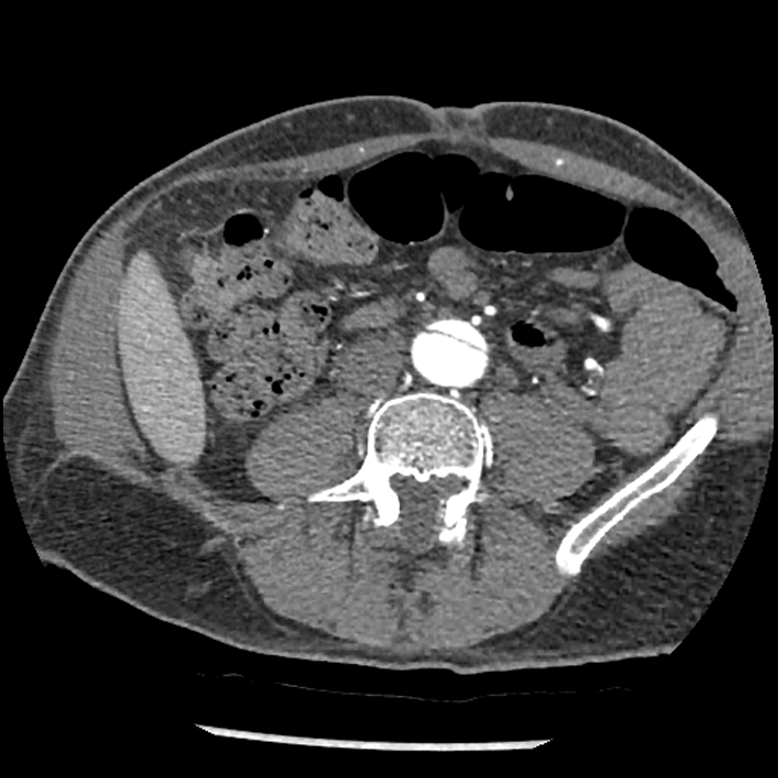 Aortic dissection - DeBakey Type I-Stanford A (Radiopaedia 79863-93115 A 60).jpg