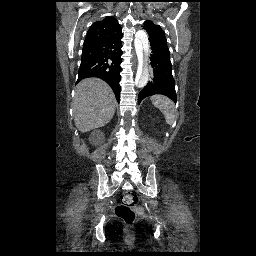 File:Aortic dissection - Stanford type B (Radiopaedia 88281-104910 B 64).jpg