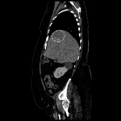 File:Aortic dissection - Stanford type B (Radiopaedia 88281-104910 C 15).jpg