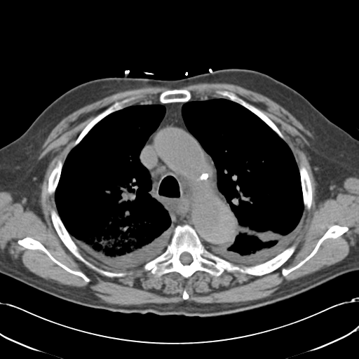 Aortic intramural hematoma (Radiopaedia 34260-35540 Axial non-contrast 21).png
