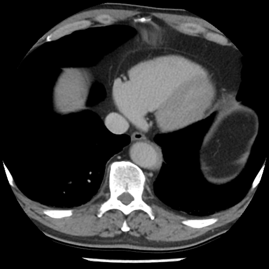 File:Aortic intramural hematoma (type B) (Radiopaedia 79323-92387 Axial C+ delayed 43).jpg