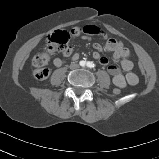 Aortic intramural hematoma from penetrating atherosclerotic ulcer (Radiopaedia 31137-31836 A 123).jpg