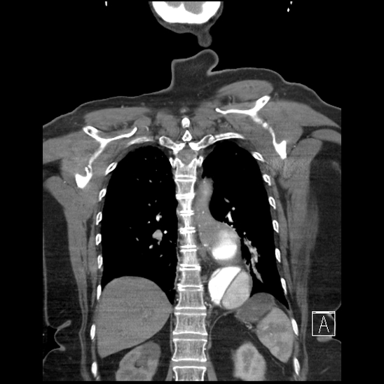 Aortic intramural hematoma with dissection and intramural blood pool (Radiopaedia 77373-89491 C 48).jpg