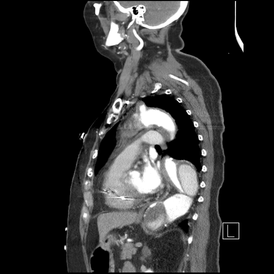 File:Aortic intramural hematoma with dissection and intramural blood pool (Radiopaedia 77373-89491 D 54).jpg