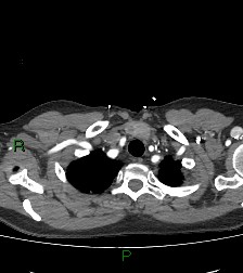 File:Aortic valve endocarditis (Radiopaedia 87209-103485 C 11).jpg