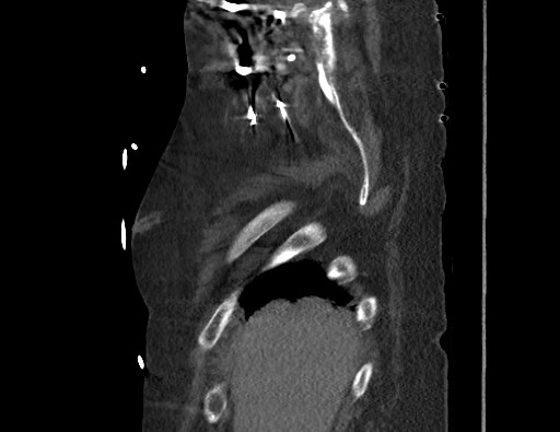 Aortoesophageal fistula with endovascular repair (Radiopaedia 73781-84592 Sagittal C+ CTPA 8).jpg