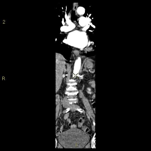 File:Aortoiliac occlusive disease (Radiopaedia 16828-16548 B 40).jpg