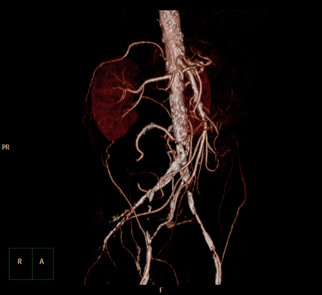 File:Aortoiliac occlusive disease (Radiopaedia 32134-33076 VR C+ arterial phase 3).jpg