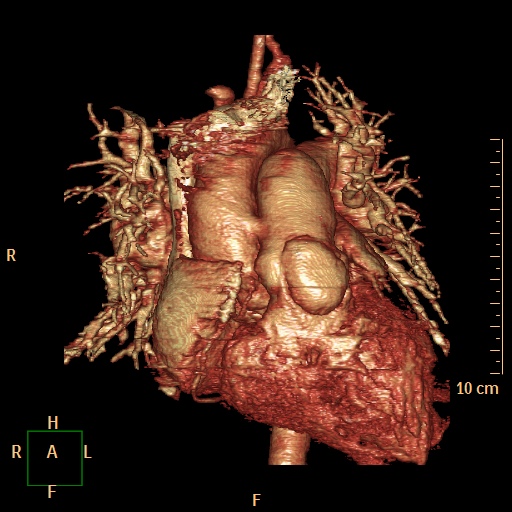File:Aortopulmonary septal defect (Radiopaedia 41990-45013 3D reconstruction 1).jpg