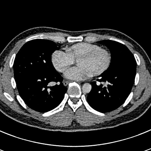 Apical lung mass mimic - neurogenic tumor (Radiopaedia 59918-67521 A 50).jpg