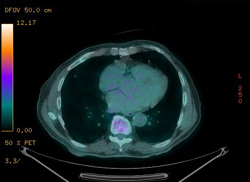 Appendiceal adenocarcinoma complicated by retroperitoneal abscess (Radiopaedia 58007-65041 Axial PET-CT 80).jpg