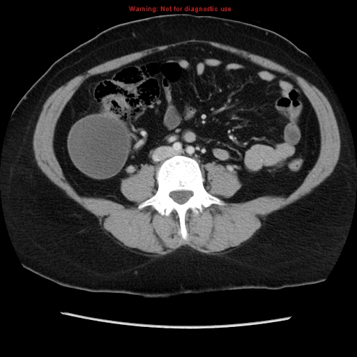 Appendiceal mucinous cystadenoma (Radiopaedia 8263-9111 Axial liver window 48).jpg