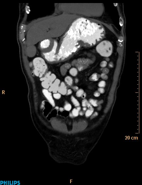 Appendiceal mucocoele (Radiopaedia 29449-29917 E 50).jpg