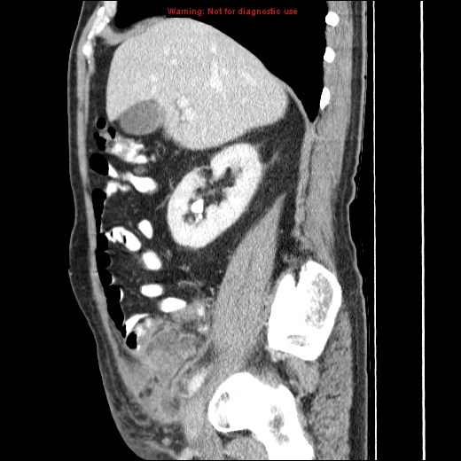 File:Appendicitis mass in inguinal hernia (Radiopaedia 26858-27029 C 16).jpg