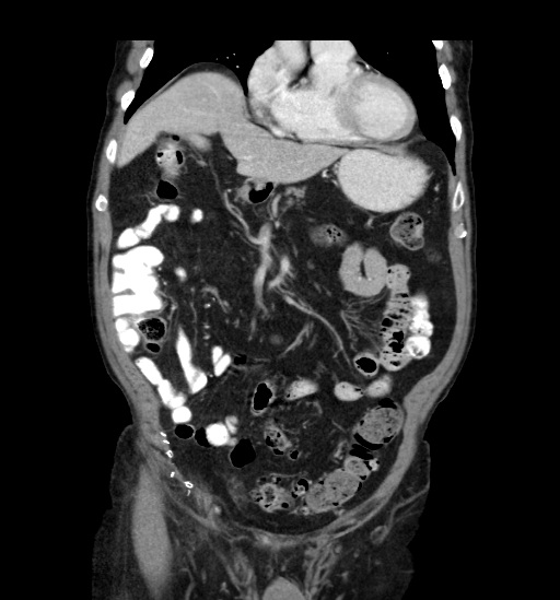Appendicitis with localized perforation and abscess formation (Radiopaedia 49035-54130 B 17).jpg