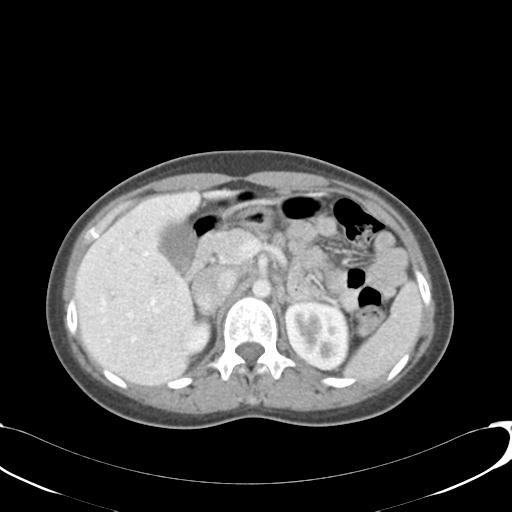 File:Appendicitis with minimal stranding but appendicolith (Radiopaedia 29035-29397 A 26).jpg