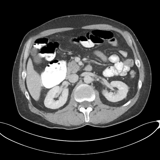 Appendicitis with thickening of the terminal ileum (Radiopaedia 42432-45550 A 38).png