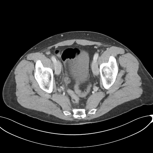 Appendicitis with thickening of the terminal ileum (Radiopaedia 42432-45550 A 84).png