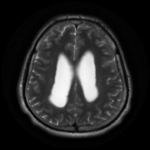 File:Aqueduct stenosis with corpus callosum hypoattenuation post shunting (Radiopaedia 37212-38969 Axial T2 16).png