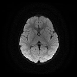Arachnoid cyst - middle cranial fossa (Radiopaedia 86780-102938 Axial DWI 14).jpg