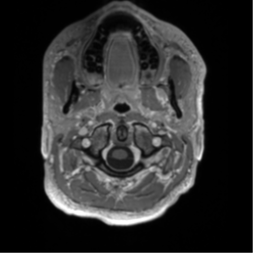 Arachnoid cyst with subdural hematoma (Radiopaedia 85892-101743 Axial T1 C+ 3).png