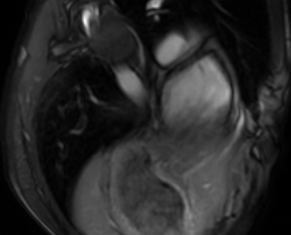 Arrhythmogenic right ventricular cardiomyopathy (Radiopaedia 69564-79464 4ch cine 151).jpg