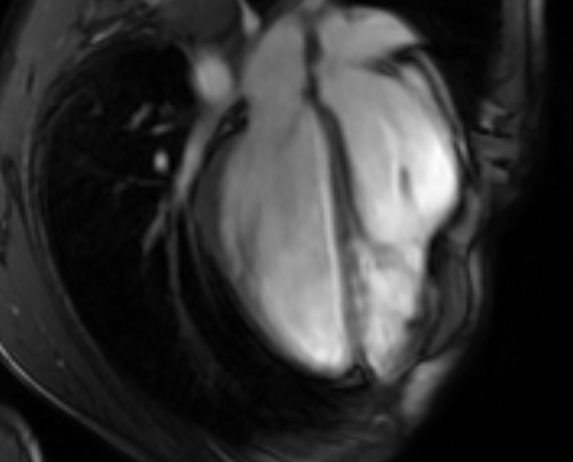 File:Arrhythmogenic right ventricular cardiomyopathy (Radiopaedia 69564-79464 4ch cine 78).jpg