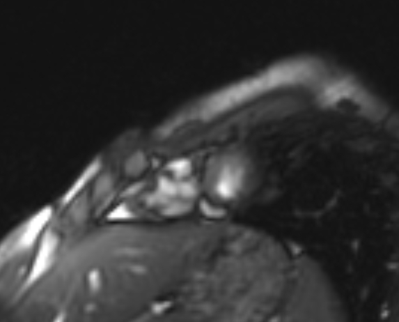 Arrhythmogenic right ventricular cardiomyopathy (Radiopaedia 69564-79464 short axis cine 27).jpg