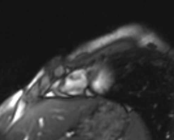 Arrhythmogenic right ventricular cardiomyopathy (Radiopaedia 69564-79464 short axis cine 29).jpg