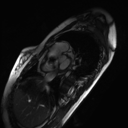 Arrhythmogenic right ventricular cardiomyopathy (Radiopaedia 87505-103850 short axis Cine SSFP 259).jpg