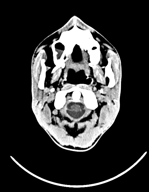 Arrow injury to the brain (Radiopaedia 72101-82607 Axial non-contrast 47).jpg