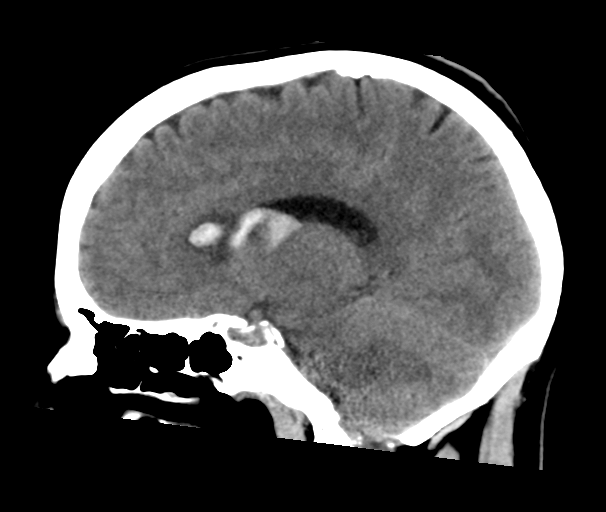 File:Arteriovenous malformation (cerebral) (Radiopaedia 40070-42579 B 19).png