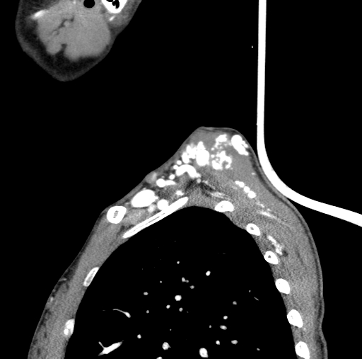 Arteriovenous malformation of the neck (Radiopaedia 53935-60062 C 7).jpg