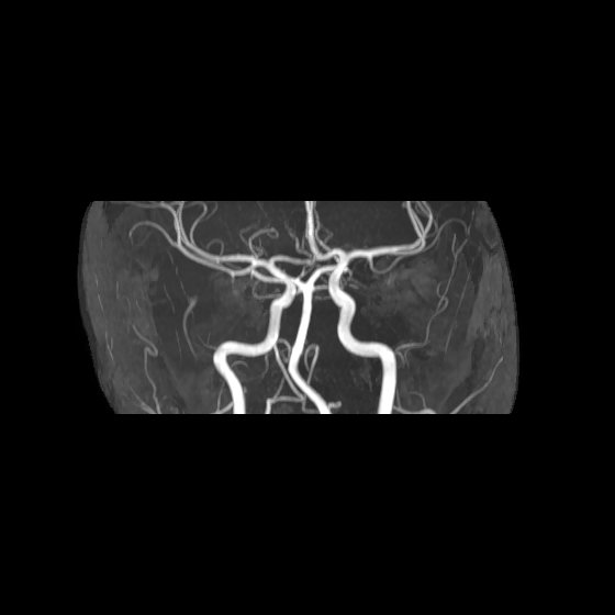 File:Artery of Percheron infarct (Radiopaedia 40966-43676 G 28).jpg