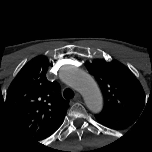 Artery of Percheron infarct (Radiopaedia 48088-52894 A 3).jpg