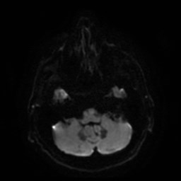 File:Artery of Percheron infarct (Radiopaedia 48088-52928 Axial DWI 8).jpg