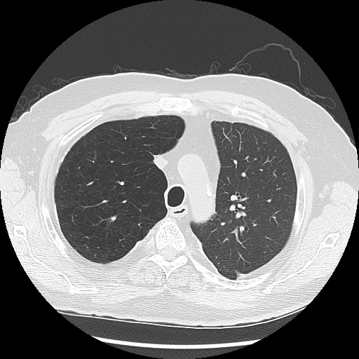 Asbestos-related pleural disease (Radiopaedia 74366-85250 Axial lung window 34).jpg