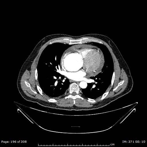 File:Ascending aortic aneurysm (Radiopaedia 50086-55404 A 50).jpg