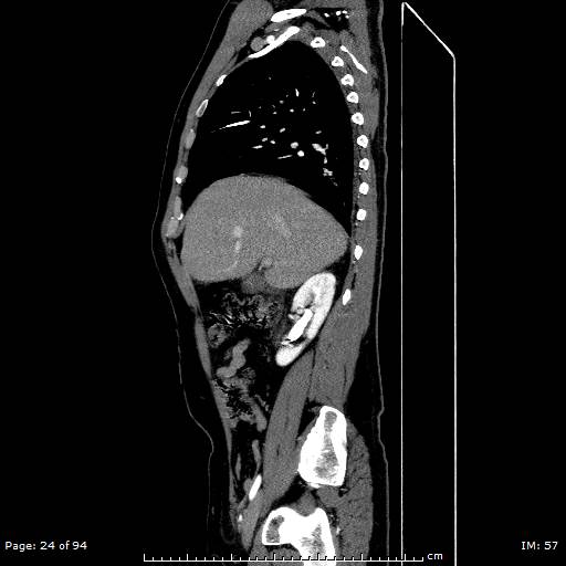 Ascending aortic aneurysm (Radiopaedia 50086-55404 C 17).jpg