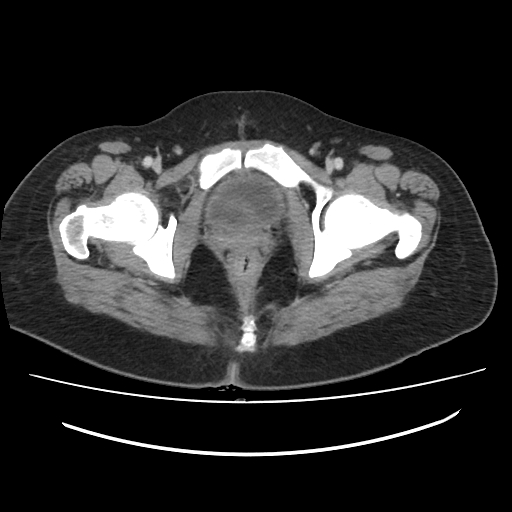 Ascending retrocecal appendicitis with liver abscesses (Radiopaedia 60066-67615 B 89).jpg