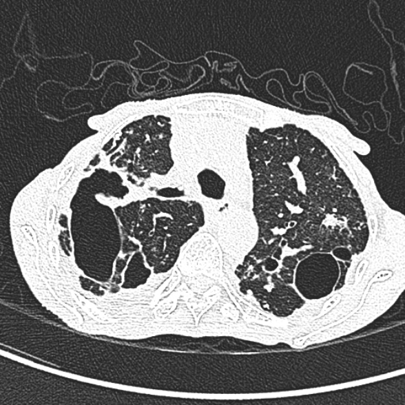 Aspergilloma- with Monod sign (Radiopaedia 44737-48532 Axial lung window 87).jpg