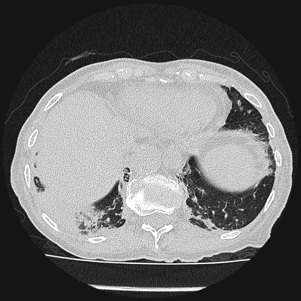 Aspergilloma (Radiopaedia 24458-24763 Axial lung window 58).jpg