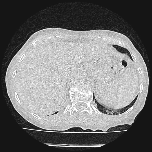 Aspergilloma (Radiopaedia 24458-24763 Axial lung window 64).jpg