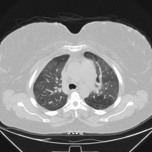 Aspergilloma (Radiopaedia 39611-41932 Axial lung window 40).jpg