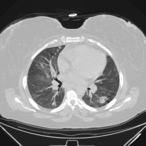 Aspergilloma (Radiopaedia 39611-41932 Axial lung window 67).jpg