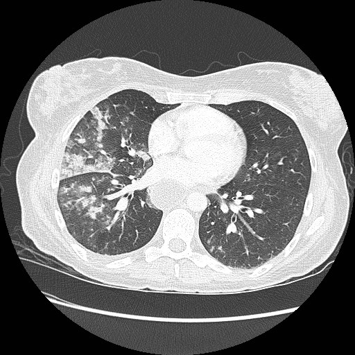 File:Aspiration pneumonia secondary to laparoscopic banding (Radiopaedia 18345-18183 lung window 64).jpg