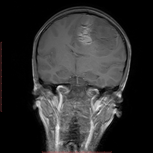 File:Astroblastoma (Radiopaedia 74287-85162 Coronal T1 11).jpg