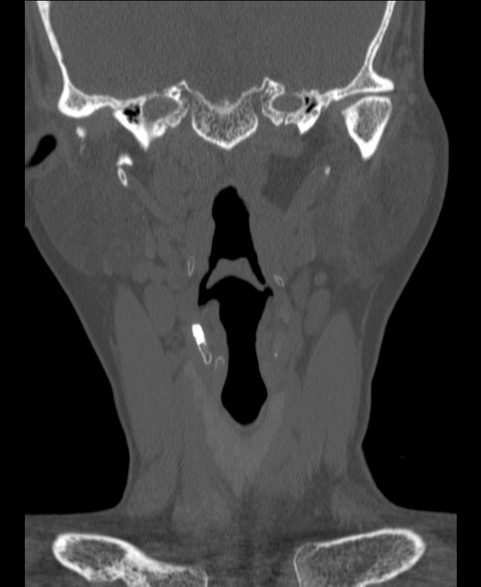 Atlanto-occipital assimilation with basilar invagination (Radiopaedia 70122-80188 Coronal bone window 19).jpg