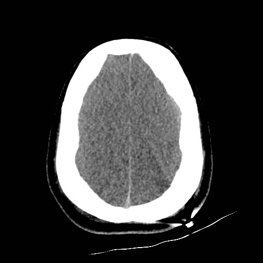 File:Atlanto-occipital dislocation (Radiopaedia 44648-48412 Axial non-contrast 45).jpg