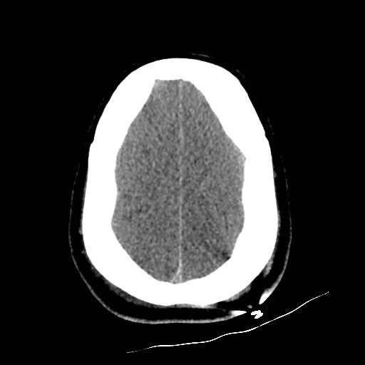 Atlanto-occipital dislocation (Radiopaedia 44648-48412 Axial non-contrast 46).jpg
